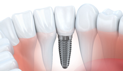 Dental Implants