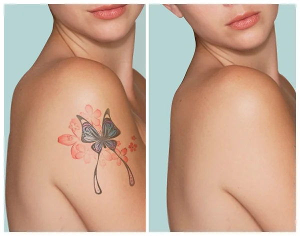 Tattoo Removal